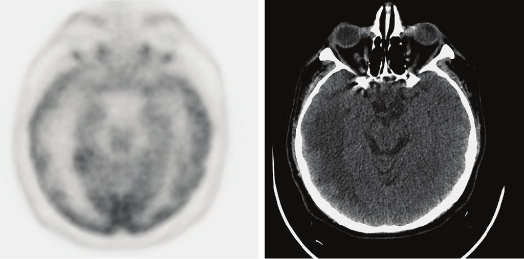 PET/ MR ünitesinde görüntülenen hastaların 1146 sı (%92) erişkin, 97 si (%8) ise pediatrik yaş grubundan hastalardır. Hastaların ortalama yaşı, 52±18 dir.