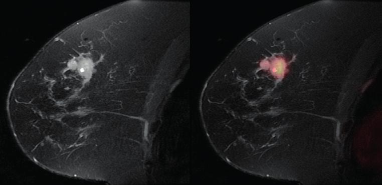 Yüksek rezolüsyonlu MR görüntülerine ek olarak, difüzyon ağırlıklı MR görüntüleri ve ADC haritası izlenmektedir.