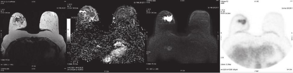 Akciğer Kanserleri ve Pulmoner Nodüller 1. Primer evreleme amacıyla alınan FDG PET/BT görüntüsü.