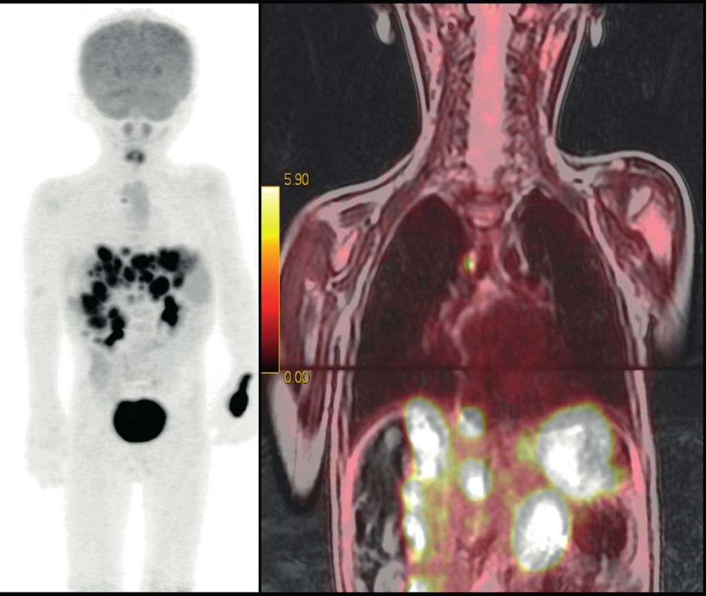 BT görüntülerinin milimetrik pulmoner nodüllerin değerlendirilmesindeki başarısına rağmen, MR görüntülerinde de fokal