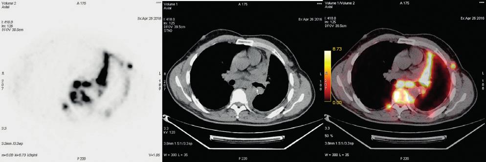Metastatik akciğer karsinoid tümör tanılı hastada yeniden evreleme amacıyla yapılan Ga-68 DOTATATE PET/BT (üstte) ve PET/MR