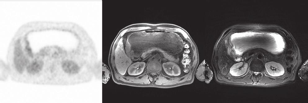 Aynı hastada ek olarak beyin ve karaciğere yönelik alınan PET/MR görüntüleri.