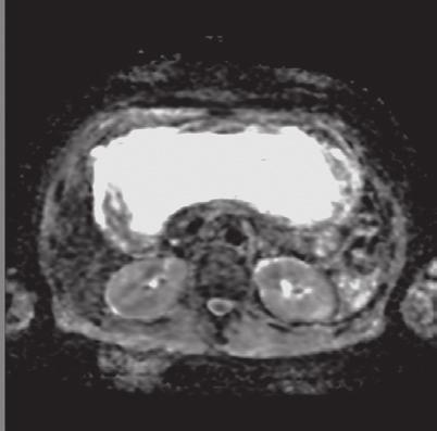 Alınan FDG PET görüntülerinde mide distal kesiminde hafif düzeyde artmış FDG tutulumu izlenirken (SUVmaks: 2,1), aynı