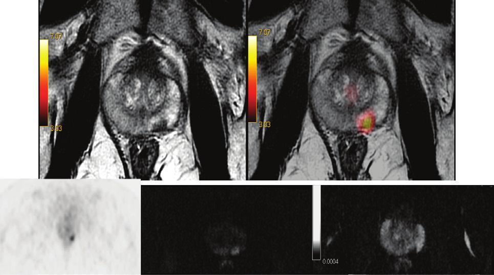 73 prostat bezi sağ periferik zonda ve santral kesiminde radyofarmasötiğin tutulumu izlenirken BT görüntülerinde anatomik lezyon ayırt edilememektedir.