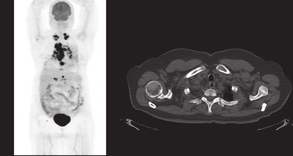 PET MIP görüntülerinde (solda) intramedüller alanlarda yaygın multifokal FDG tutulumları izlenirken, tüm vücut difüzyon ağırlıklı görüntülerde de (sağda) kemik iliğinde farklı bölgelerde multifokal