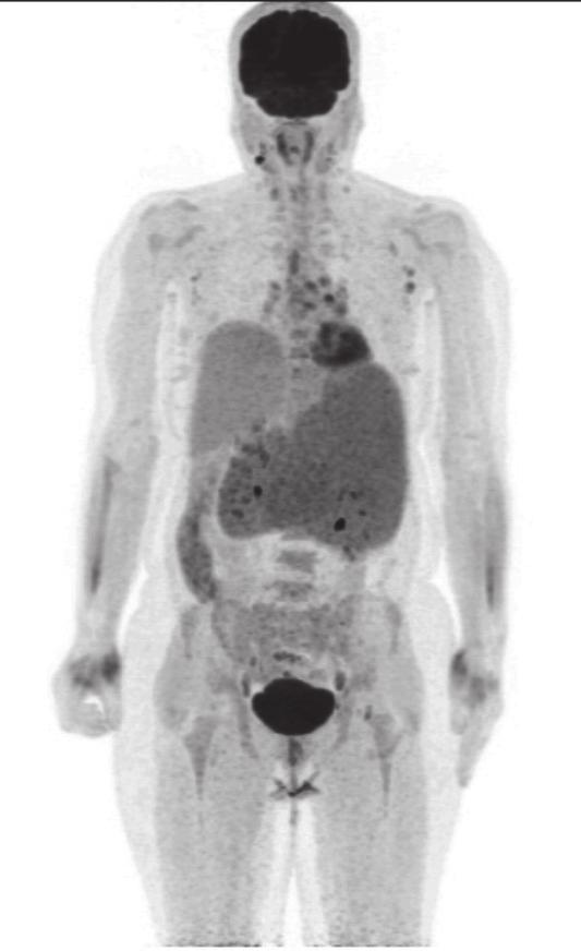 Kemik yapıların ve intramedüller alanların değerlendirilmesi için alınan koronal T2 ve STIR görüntülerinde intramedüller alanlarda yaygın sinyal artışları izlenmekte olup, vertebra, pelvis ve sol