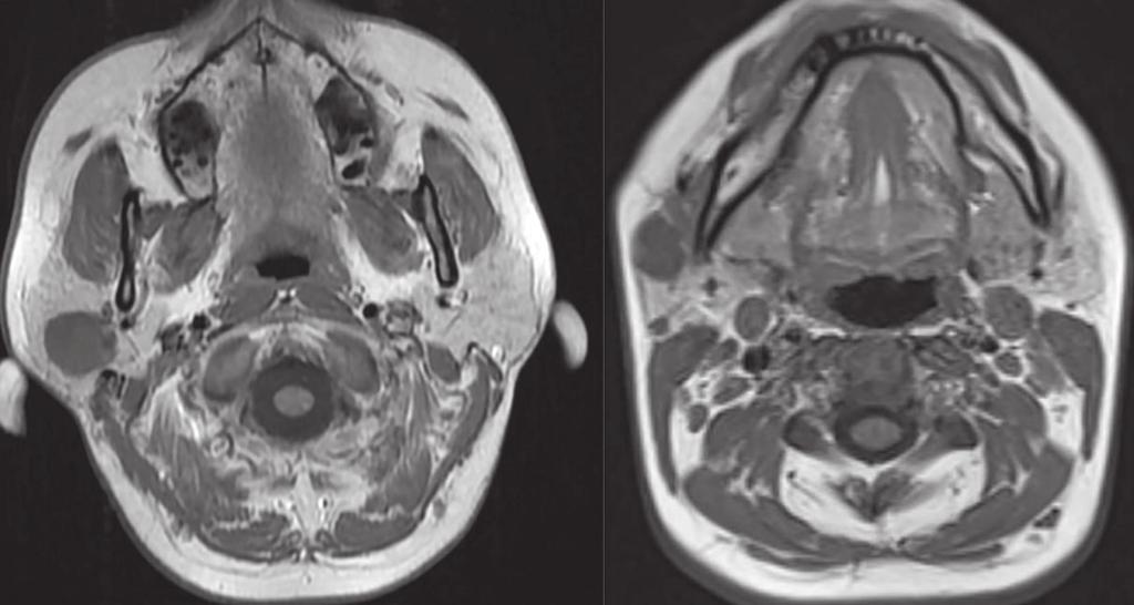 Olgu 3 (sol) ve Olgu 4 (sağ) teki hastanın sağ parotis yüzeyel lobdaki kitlesinin MRG de aksiyel kesitte gosterilmesi. olması üzerine yapıldı.