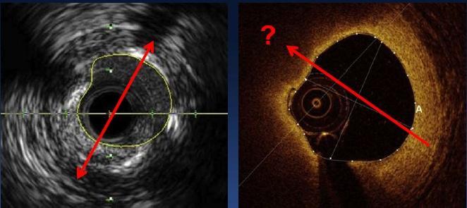 OCT stent optimizasyonu IVUS destekli PKG MACE Eksternal elastik membran? Damar çapı, plak yükü?