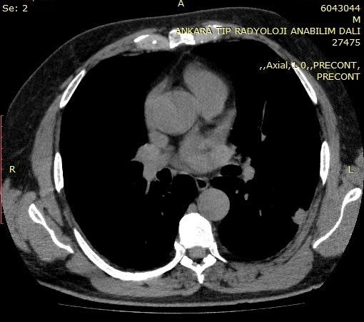 Sonuç olarak yeni sınıflama sisteminde bronkoalveolar karsinom başlığı parçalanmış; in-situ adenokanser, minimal invaziv