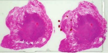 AKCİĞER KÜÇÜK HÜCRELİ DIŞI KARSİNOMLARINDA PATOLOJİNİN DEĞİŞEN ROLÜ 15 2- Bronkioloalveoler karsinomlar (BAK) 5 farklı alt gruba ayrıldı.