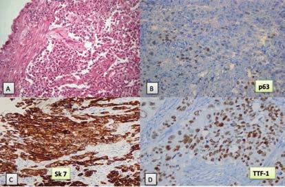 AKCİĞER KÜÇÜK HÜCRELİ DIŞI KARSİNOMLARINDA PATOLOJİNİN DEĞİŞEN ROLÜ 17 kobik biyopside, az diferansiye bir karsinomda immunhistokimyasal inceleme ile tanıya gidişin örneği verilmiştir (Resim 3