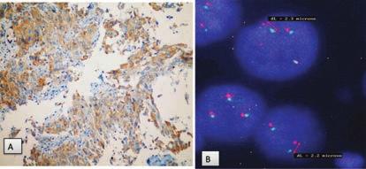 AKCİĞER KÜÇÜK HÜCRELİ DIŞI KARSİNOMLARINDA PATOLOJİNİN DEĞİŞEN ROLÜ 19 fomalar arasında ALK nın adını aldığı Anaplastik büyük hücreli lenfoma olgularında ya da İnflamatuar myofibroblastik tümör