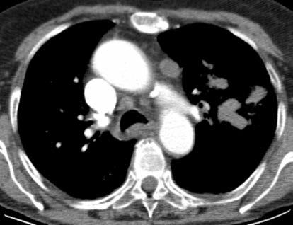 Sol akciğer üst lobda primer tümör ve her iki akciğer parankiminde yaygın nodüler metastazlar.