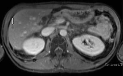 Nodal evrelemede kullanılan Mountain-Dresler American Thoracic Society haritalamasına göre lenf nodlarının lokalizasyonları belirlenmiş olupsubsegmental (L14), segmental (L13), lobar (L12),