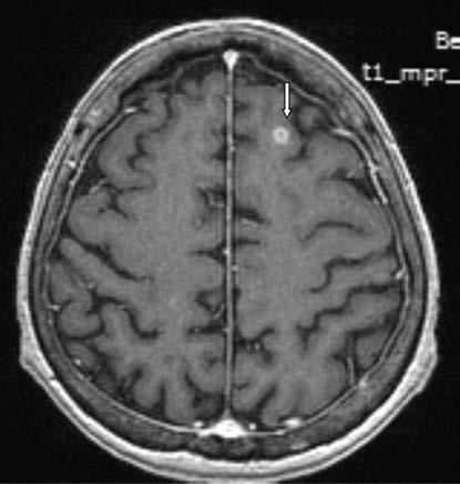 38 AKCİĞER KANSERLERİNDE RADYOLOJİK GÖRÜNTÜLEME tedaviye metabolik yanıtlarının değerlendirilmesinde PET-BT kullanılabilmektedir. Resim 5. Akciğer adeno CA tanılı 75 yaşında kadın hasta.