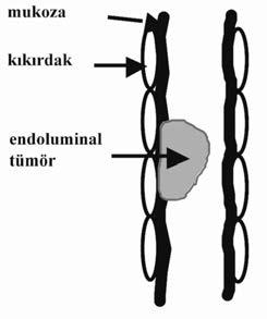 İşlem sırasında bronkoskobun kendisinin de havayolunu tıkaması ve işlem sonrasında gelişebilecek bronkospazm ve ödem nedeniyle fleksibl bronkoskopi, zor ve tehlikeli bir girişim olabilir.