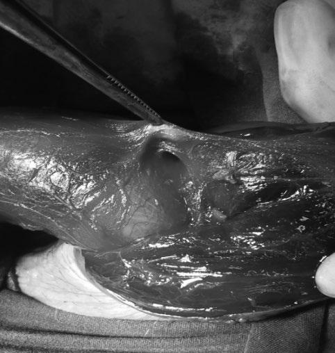 Ekici ve ark. Penisin süperfisial dorsal ven rüptürü Giriş Seksüel ilişki sırasında akut başlangıçlı şişlik, ekimoz ve ağrı olması aksi ıspatlanıncaya kadar penil fraktür olarak bilinmektedir (1).