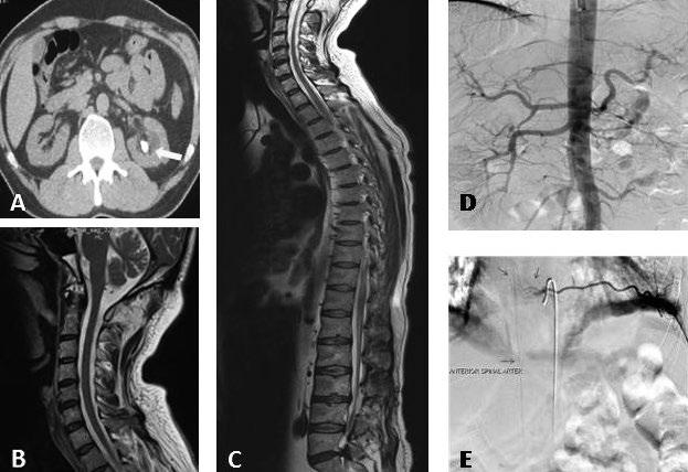 Bolat et al. Paraplegia after PNL Introduction Percutaneous nephrolithotomy (PNL) is commonly used minimally invasive method for treatment of urinary stone disease greater than 2 cm in diameter.