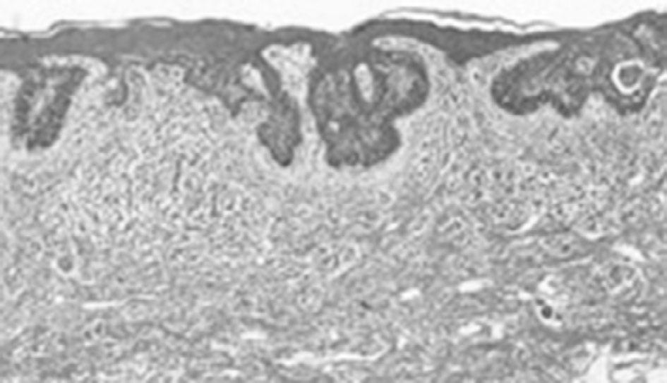 Tuğcu ve ark. Laparoskopik retroperitoneal kitle eksizyonu Resim 4. Embriyonel karsinom metastazı Hemotoksilen Eozin %20-50 kür sağlanabileceğini dile getirmektedirler (11).