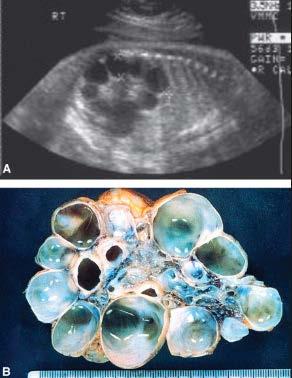 29 Renal displazi oluşumunda iki farklı teori üretilmiştir: 1. İntrauterin dönemde üriner toplayıcı sistemdeki bir tıkanıklık, 2.