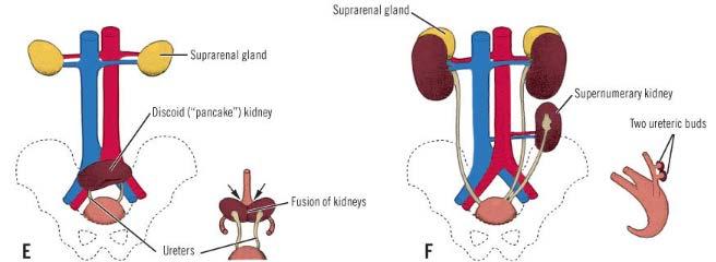 renal ektopi E) Pelviste birleşen