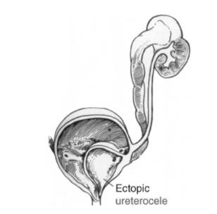 40 Üreterosel, üreterin intravezikal submukozal kısmının kistik genişlemesidir. Dış kısımda mesane dokusu, iç kısmında epitel örtüsü vardır (157).
