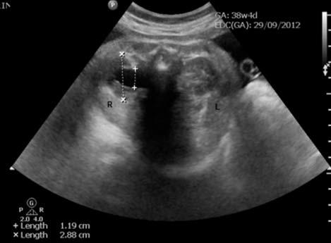 48 faktörlerdir. Antenatal HN lerin %80 i ikinci trimestirde kendiliğinden düzelir (187).