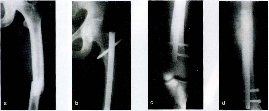 Kilitli intramedüller çivileme uygulamaları 141 Şekil 1 : a. 36 yaşında erkek hasta sol femur diafiz fraktürü preoperatif grafisi. b. erken postoperatif grafisi, c. erken postoperatif grafisi, d.