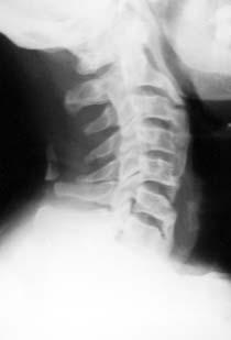 GİRİŞ Diffüz idiopatik iskelet hiperostozu (DISH), radyografik olarak, disk aralığında daralma, osteoporoz, ankiloz olmadan torasik, lomber ve servikal omurganın ön ve yan spinal ligamentlerini
