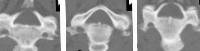 Şekil 3-A (C3) Şekil-3-B (C4) Şekil-3-C (C5) Şekil 3-D (C6) Şekil 3-E (C7) Şekil 3-F (T1) Şekil 3: Servikal aksiyel kesit bilgisayarlı tomografi kemik pencere görüntüleri (A,B,C,D,E,F).