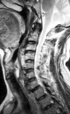 Şekil 4-A Şekil 4-B Şekil 4: Manyetik rezonans görüntülemede, epiglottis ve supralaringeal bölge seviyesinde hiperosteoz anterior yapılara bası yaptığı, disk mesafelerinin, spinal kanalın ve