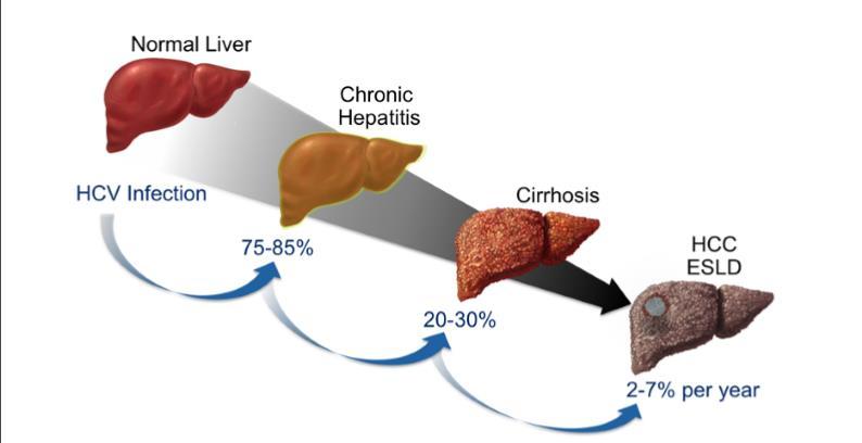 Kronikleşme HCV infeksiyonu olan hastaların yaklaşık