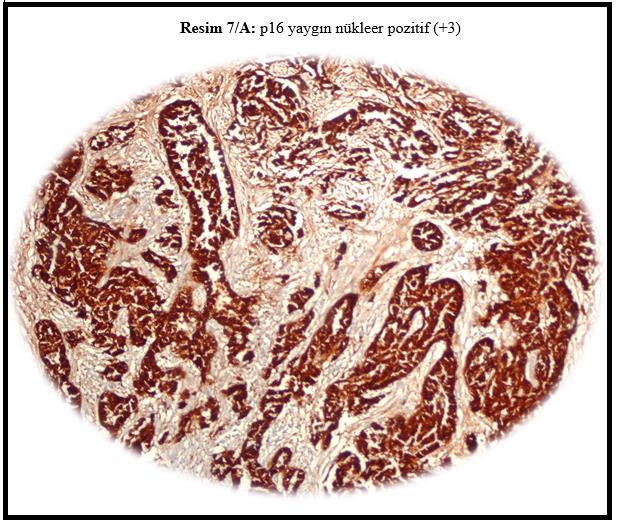 p16 ekspresyonu, MM olgularında % 65,8 oranında negatif bulunmuştur. Olguların %34,2 si pozitiftir.