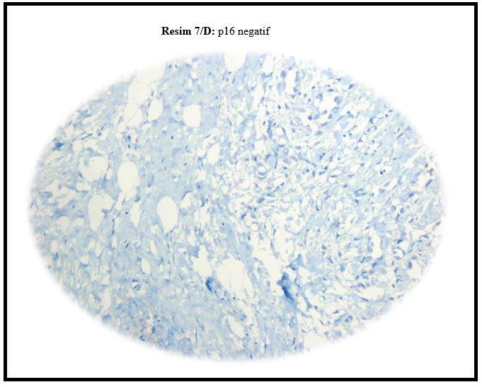 Tiplere göre bakıldığında p16, epitelioid tipte %48,6 oranında pozitif bulunmuştur.