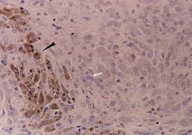 MR ile nodül içeriğinde hemosiderin artışı ile düşük sinyal intensitesi, yağ artışı ile ise yüksek sinyal intensitesi saptanır (Resim 1) (7,8).