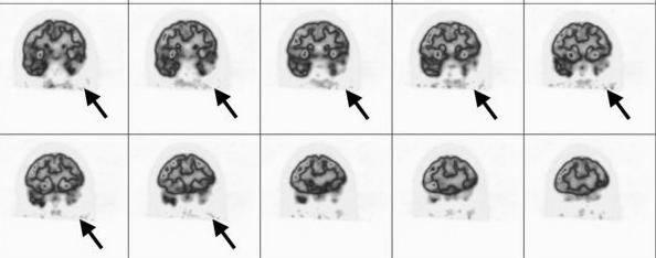 TLE de crossedserebellar diaşizis yani kontralateral serebellumda hipometabolizma izlenmesi, kompleks parsiyel nöbet sırasında güçlü bir ipsilateral frontal lob inhibisyonu olduğunu göstermektedir