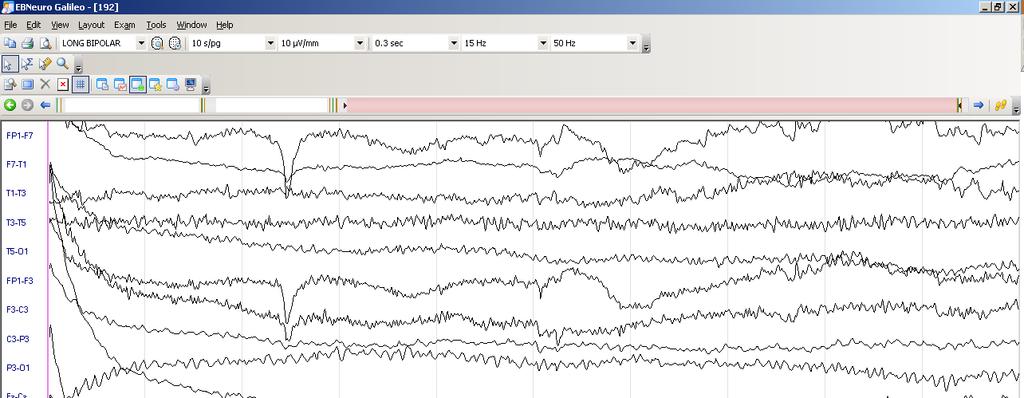 Video EEG monitorizasyon- interiktal EEG: Temporal bölgelerde solda bir miktar daha belirgin görülen düşük amplitüdlü bilateral teta ve nadiren delta aktivitesi yanında yine düşük amplitüdlü