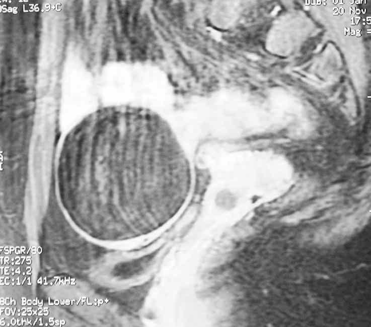 olguda sagittal T2A MRG de farkl sinyal intensite alanlar içeren (Resim 5), farkl olguda aksiyel (Resim 6) ve sagittal (Resim 7) kontrastl T1A MRG de heterojen kontrast tutulumu gösteren kistik yap