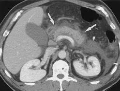 Peritonitis