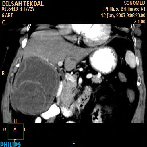 Abdominal BT