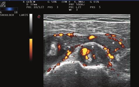 fiekil-5. Proliferatif tenosinovit. h: humerus; d: deltoid; b: biseps tendonu uzun bafl ; ( * ): tendon k l f ve çevresinde geniflleme ve sinovyal proliferasyon.