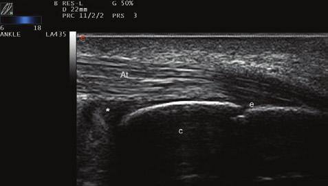 US de tendon lezyonunu düflündürecek bulgular aras nda tendon kenar düzensizlikleri, normal fibriler yap n n bozulmas, tendon k l f nda geniflleme ve tendonda y rt k say labilir.