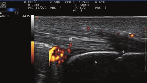 Tenosinovitin varl her iki planda (transvers ve longitudinal) gösterilmelidir (23). Tendon k l f nda geniflleme RA hastalar n n ço unda görülebilen patolojik bir US bulgusudur.