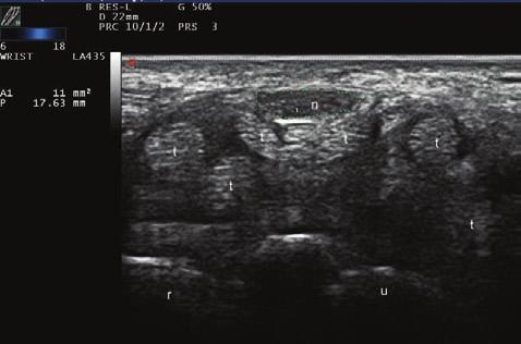 fiekil-9. Karpal tünel sendromunda median sinir çap n n US ile de erlendirilmesi. n: median sinir; t: tendon; r: radius; u: ulna. ( TF Romatoloji BD arflivinden al nm flt r).