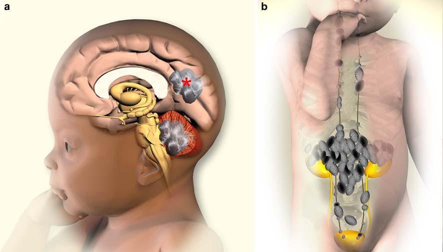 Resim 2: Nöral krestten orijinlenen sempatik sinir sisteminde ortaya çıkan, sempatik ganglia, adrenal medulla, paragangliayı içeren nöroblastomanın oluşum resimi İn vitro ortamda yapılan çalışmalarda