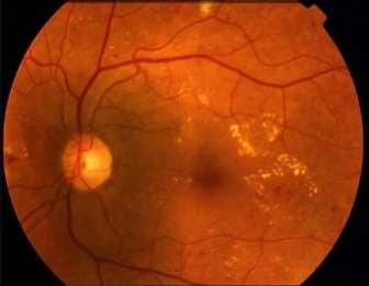 çekilir. Şekil-1 de diyabetik retinopati hastalığı görülen ve görülmeyen hastalara ait FFA görüntüleri görülmektedir. bilgileri kullanarak o örnekler hakkında karar verebilmektedir.