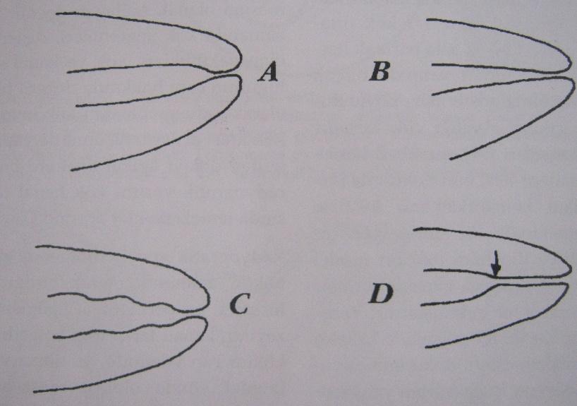 Şekil:9 Apikal foramen tipleri(7) A: geleneksel basit konstriksiyon B: gittikçe daralan C: multi konstrüksiyon D: paralel konstriksiyon Apikal konstriksiyonun korunmasının önemi: Kanal preparasyonu