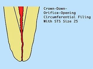 Crown-down yaklaşımında önce büyük numaralı Gates-Glidden frezler kullanılır. Daha küçük numaralı frez biraz daha derine indirilerek preparasyona devam edilir.