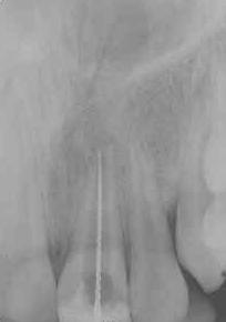kanal dolgusunda güçlük yaratır (5). Bu dişlerin apeks bölgeleri gelişim dönemine bağlı olarak üç farklı formda izlenebilir.