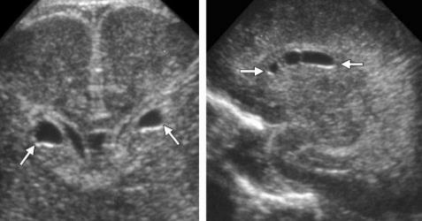 İntrakranyal Kistler: Connatal Connatal Kistler: Lateral ventrikül